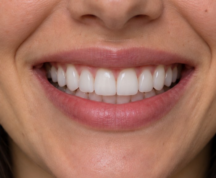After AI smile simulation
