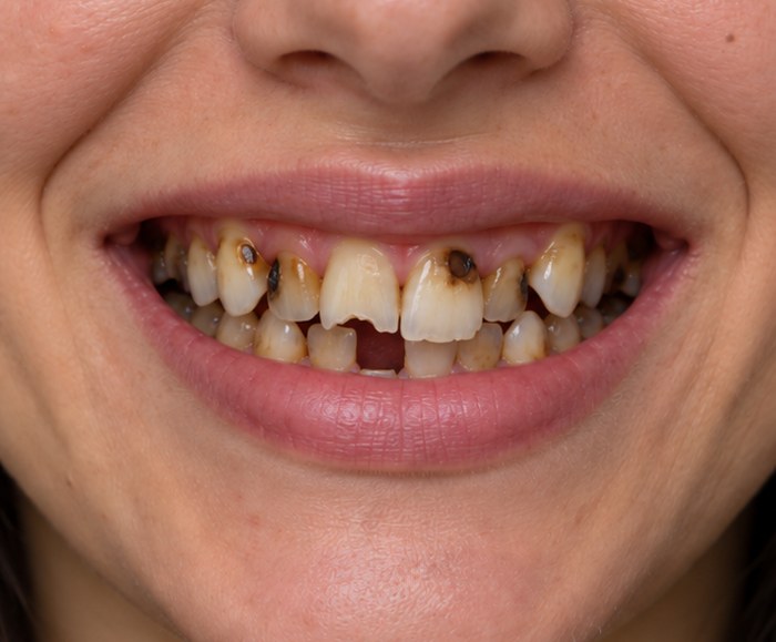 Before AI smile simulation